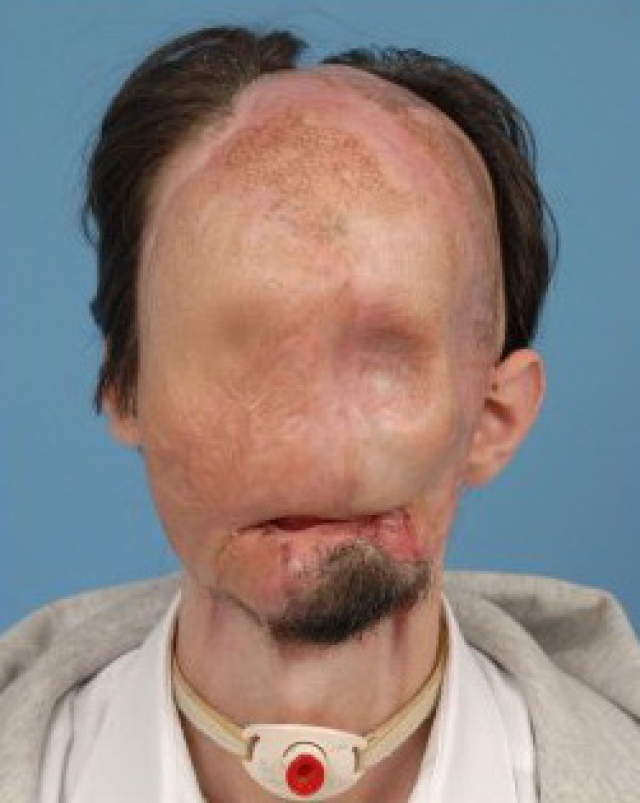 Как бы это ни было ужасно, он превратился в настоящего "человека без лица" с оголенными лицевыми костями. С целью защитить организм Далласа от последующих разрушений, врачи ввели его в искусственную кому на три месяца. 