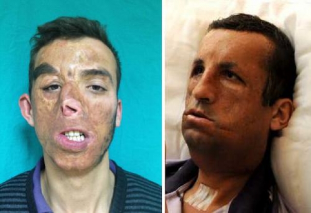 Угур Акар (Ugur Acar)  из Турции получил серьезные ожоги лице во время пожара. Он получил полную трансплантацию лица в 2012 году.