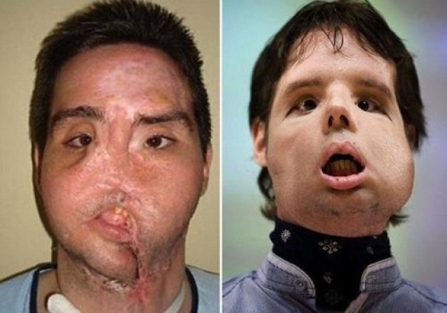 Этот человек, известный в интернете как Оскар , обычный испанский фермер. Случайно выстрелил себе в лицо. Получил полную трансплантацию лица в 2010 году.