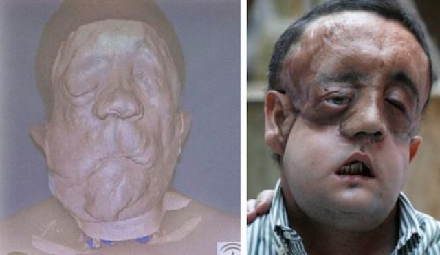 Этот человек, известный как Рафаэль. Испанский фермер, страдает нейрофиброматозом (как Паскаль Колер). Он получил частичную пересадку лица в 2010 году.