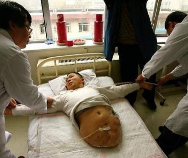 Мужчина выжил после того, как ему отрезало половину тела  В 1995 году китайца Пенг Шулина разрезало наполовину, когда он попал под грузовик. Рост оставшейся половины тела составил 66 см. 