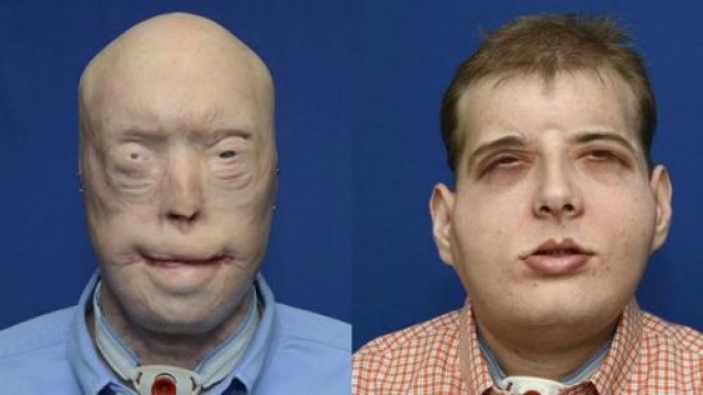 Тогда врачи решили пересадить Патрику новое лицо целиком — полный овал анфас, включая нос, уши, губы, веки.