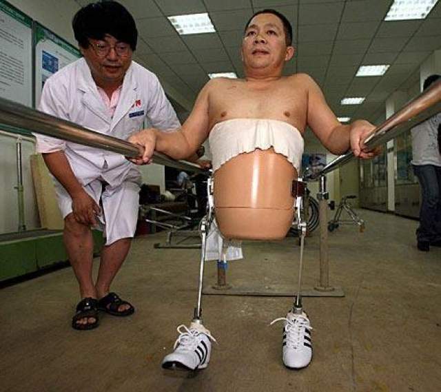 Мужчина смог не только выжить, но начал ходить благодаря специально разработанным протезам с биотическими ногами. 