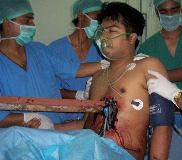 Парень выжил после того, как штырь пронзил его грудную клетку насквозь Супратим Датта, 23-летний индийский таксист 12 июля 2008 года получил страшную травму. Во время автомобильной аварии его грудь пронзил железный штырь. 