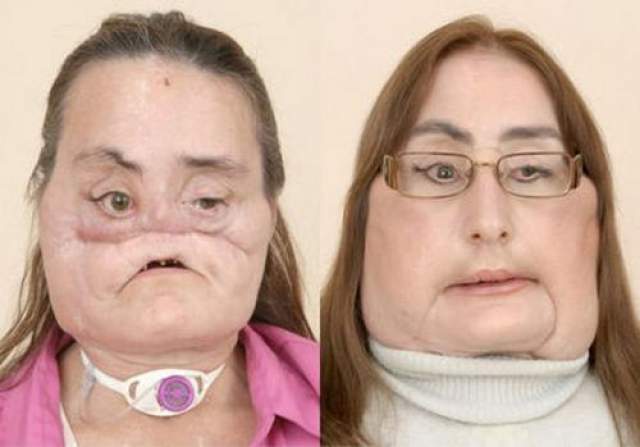 Женщине почти полностью пересадили лицо В декабре 2008 года 45-летней Конни Калп американские хирурги пересадили 80 : лицевой ткани.