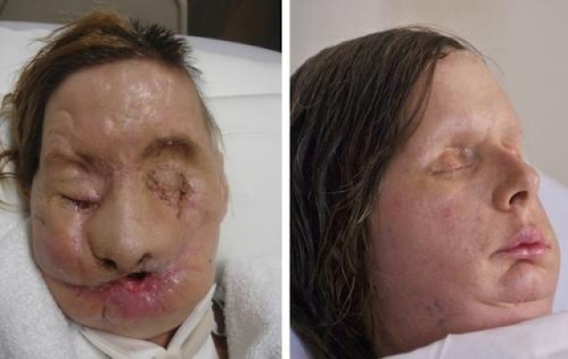 Карла Нэш (Charla Nash) из Коннектикута, сильно пострадала после того, как шимпанзе друга раздер ей лицо. Charla Nash получила полную трансплантацию лица в 2011 году.